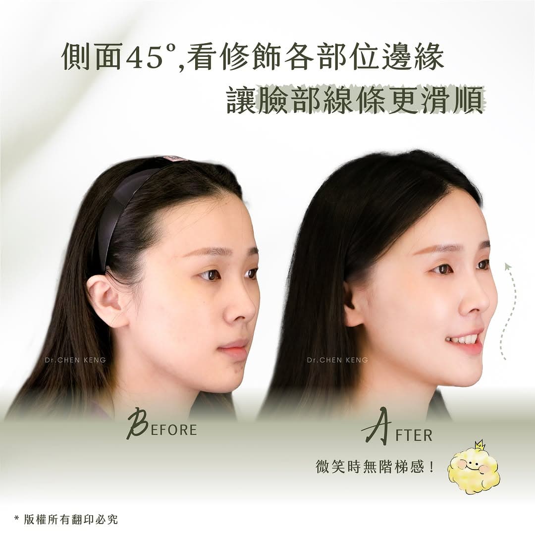 脂肪補臉